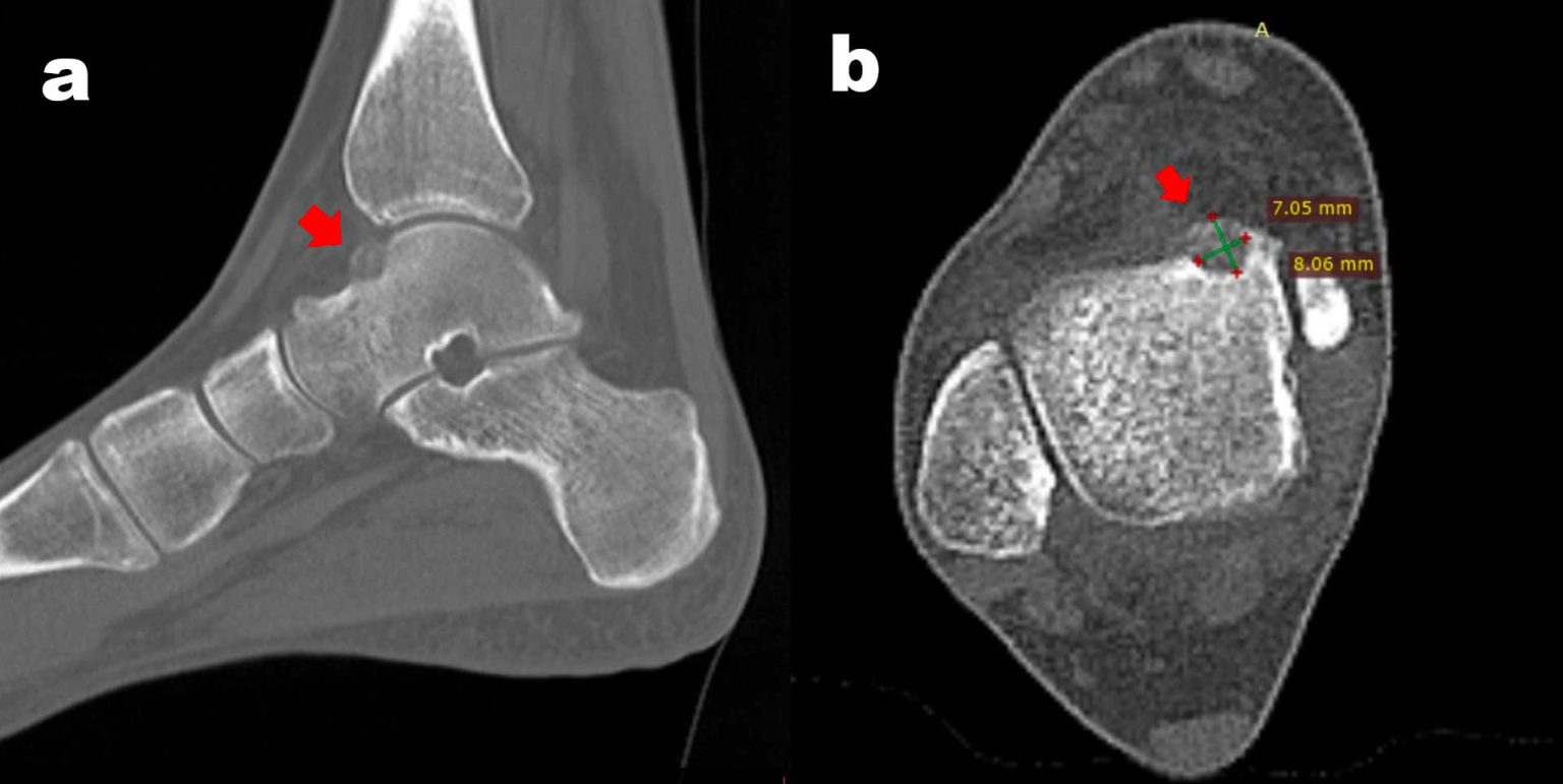 Intraarticular subperiosteal osteoid osteoma of the talar neck